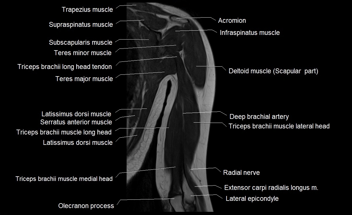 MRI upper arm (humerus ) coronal cross sectional anatomy image 20.webp